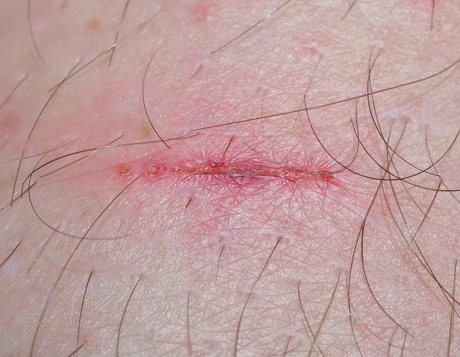 Unlocking the Body’s Secrets: The Fascinating Science of Wound Healing